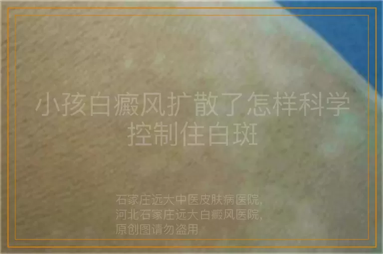小孩白癜风扩散了怎样科学控制住白斑