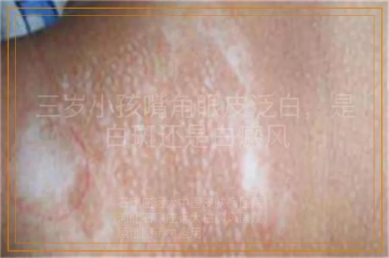 三岁小孩嘴角眼皮泛白，是白斑还是白癜风