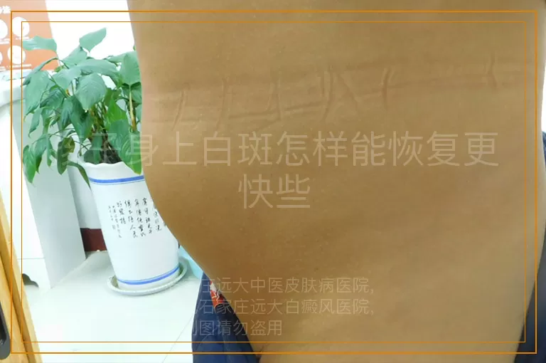 孩子身上白斑怎样能恢复更快些