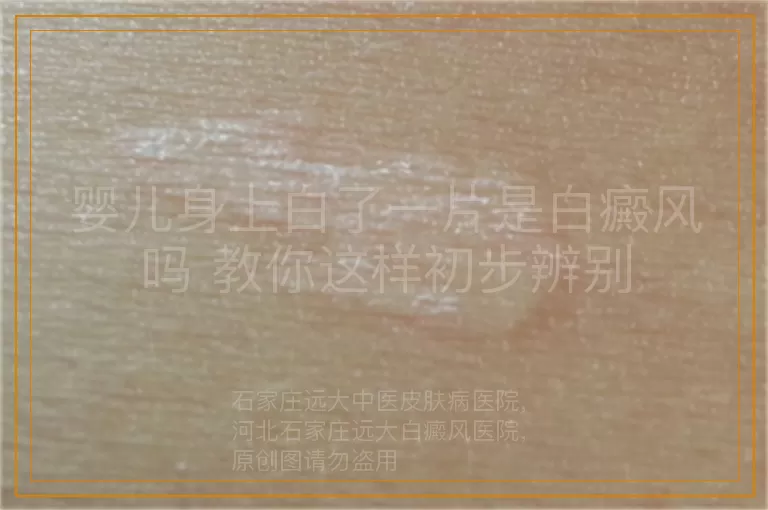 婴儿身上白了一片是白癜风吗 教你这样初步辨别