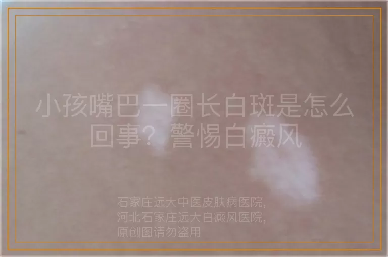 小孩嘴巴一圈长白斑是怎么回事？警惕白癜风