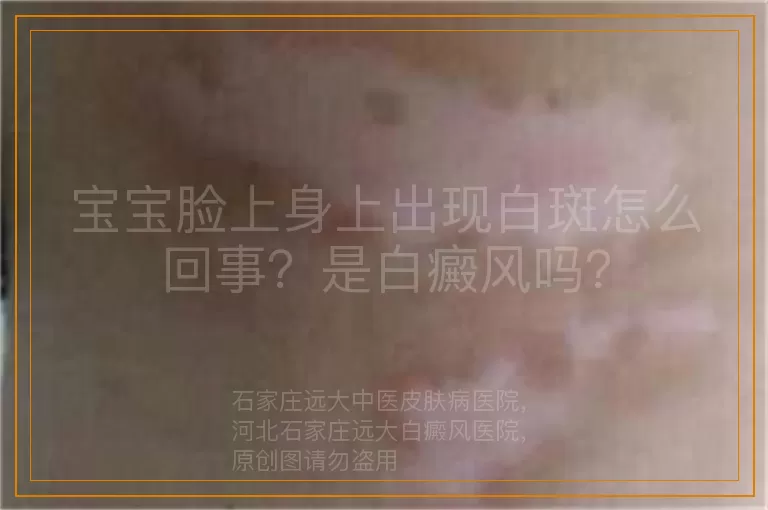 宝宝脸上身上出现白斑怎么回事？是白癜风吗？
