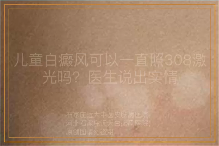 儿童白癜风可以一直照308激光吗？医生说出实情