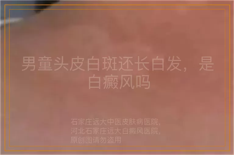 男童头皮白斑还长白发，是白癜风吗