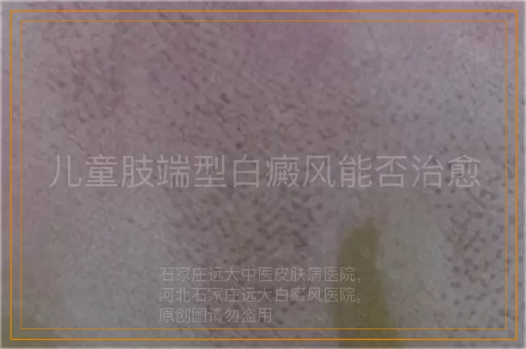 儿童肢端型白癜风能否治愈