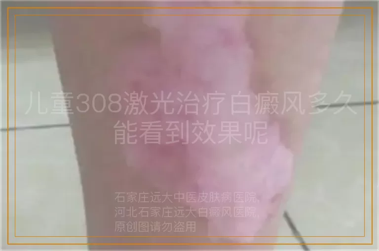 儿童308激光治疗白癜风多久能看到效果呢