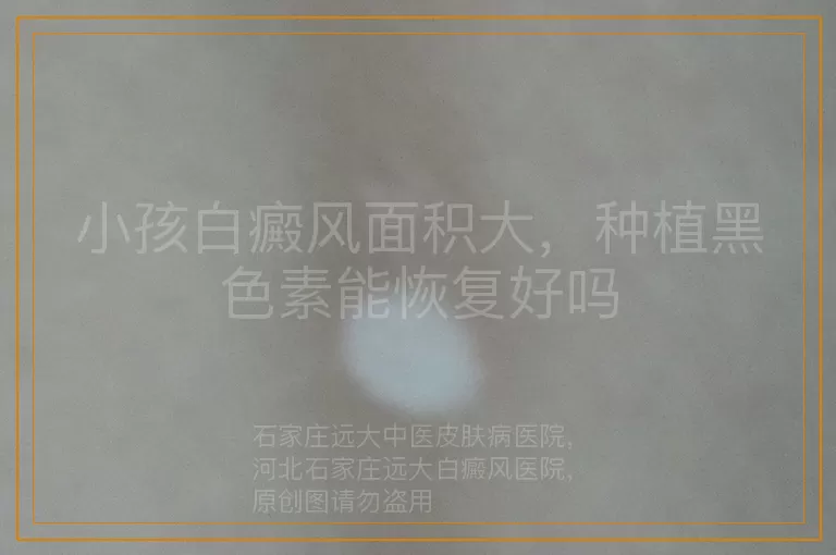 小孩白癜风面积大，种植黑色素能恢复好吗