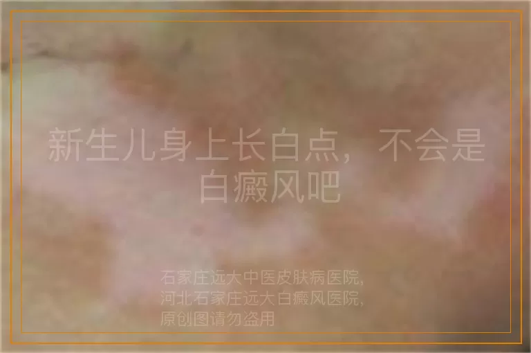 新生儿身上长白点，不会是白癜风吧