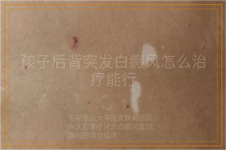 孩子后背突发白癜风怎么治疗能行