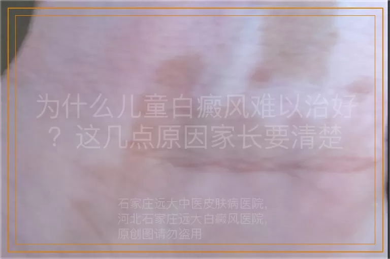 为什么儿童白癜风难以治好？这几点原因家长要清楚