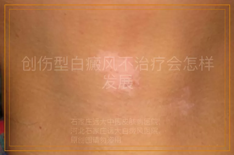 创伤型白癜风不治疗会怎样发展