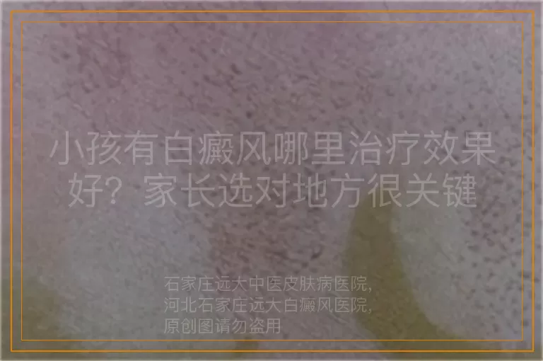 小孩有白癜风哪里治疗效果好？家长选对地方很关键