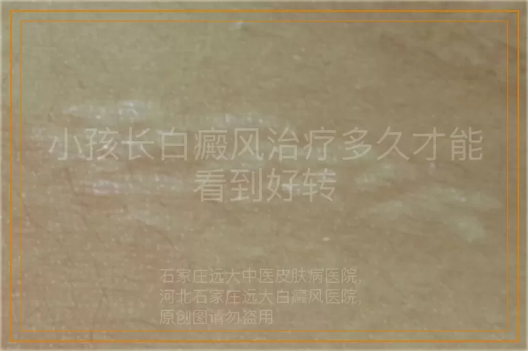 小孩长白癜风治疗多久才能看到好转