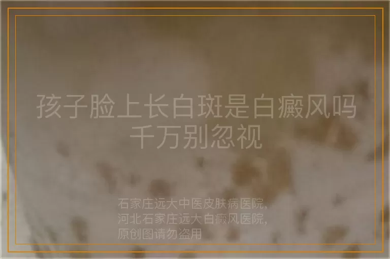 孩子脸上长白斑是白癜风吗千万别忽视