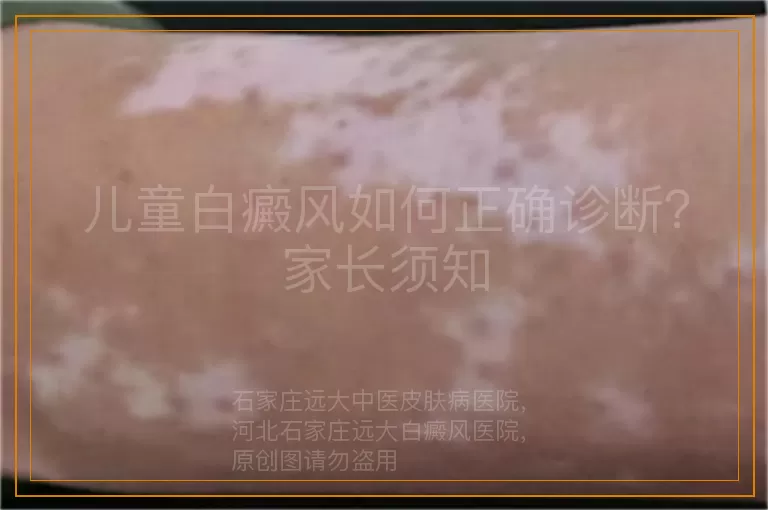 儿童白癜风如何正确诊断？家长须知