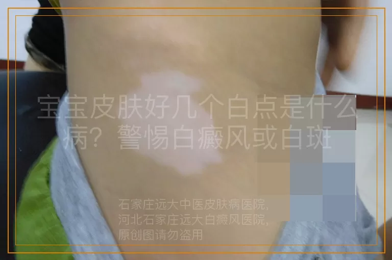 宝宝皮肤好几个白点是什么病？警惕白癜风或白斑