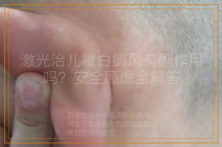 激光治儿童白癜风有副作用吗？安全顾虑全解答