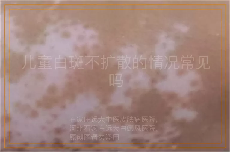 儿童白斑不扩散的情况常见吗