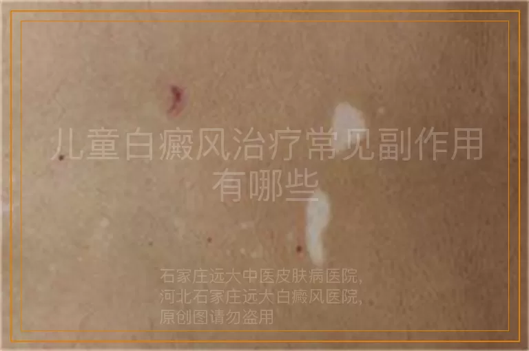 儿童白癜风治疗常见副作用有哪些