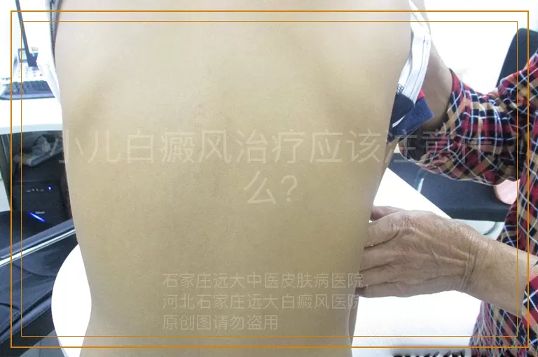 小儿白癜风治疗应该注意什么?