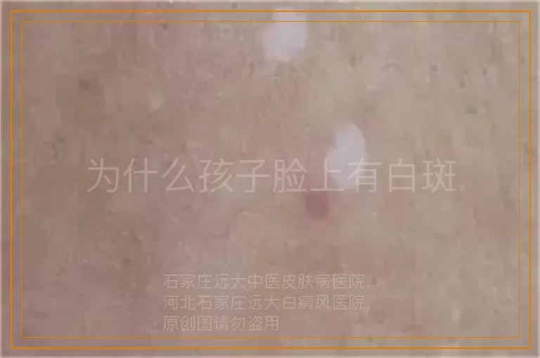 为什么孩子脸上有白斑