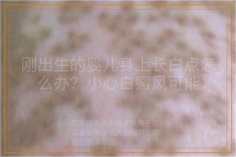 刚出生的婴儿身上长白点怎么办？小心白癜风可能