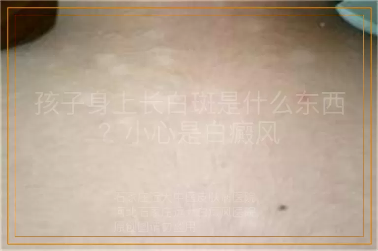 孩子身上长白斑是什么东西？小心是白癜风