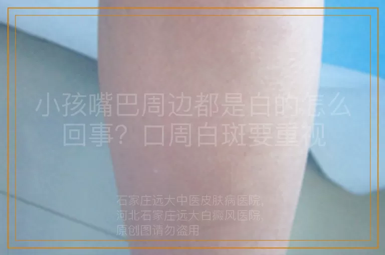 小孩嘴巴周边都是白的怎么回事？口周白斑要重视