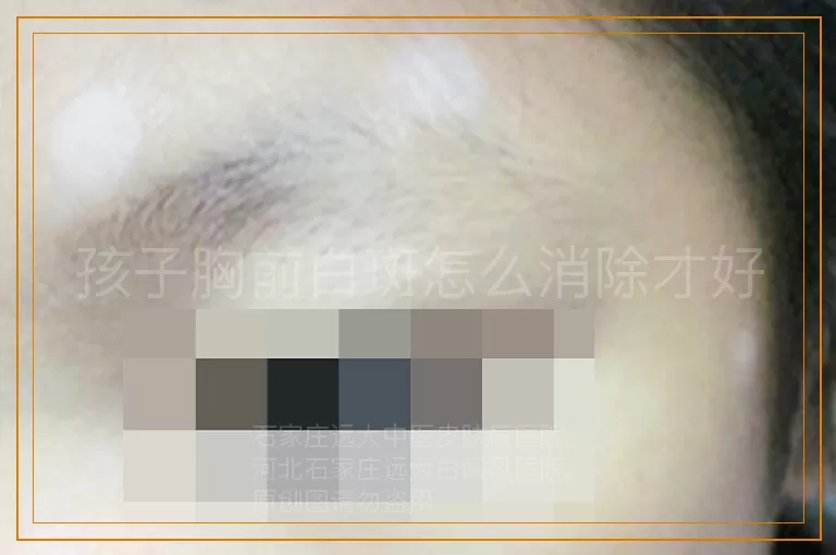 孩子胸前白斑怎么消除才好