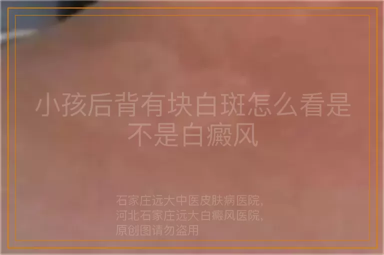 小孩后背有块白斑怎么看是不是白癜风