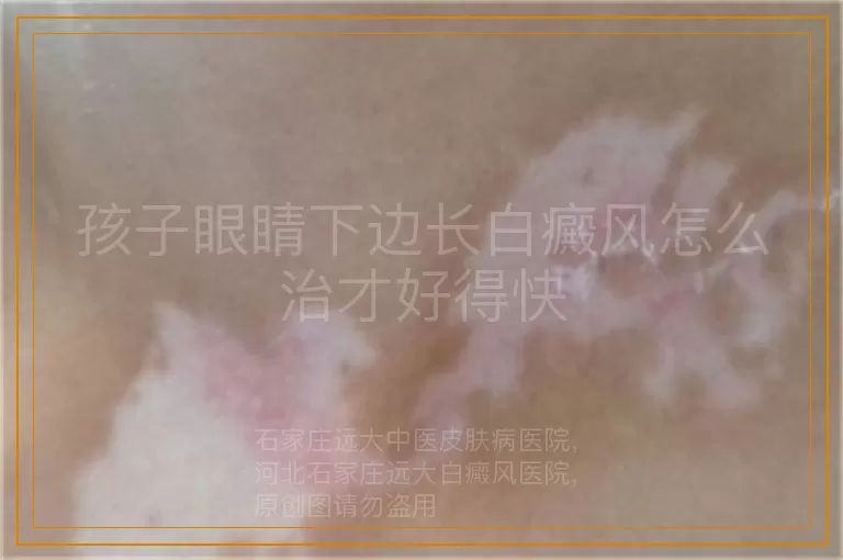孩子眼睛下边长白癜风怎么治才好得快