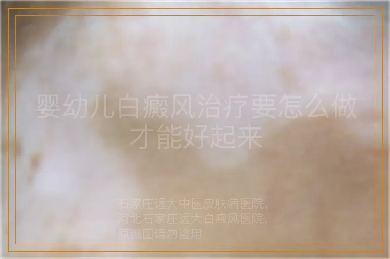 婴幼儿白癜风治疗要怎么做才能好起来