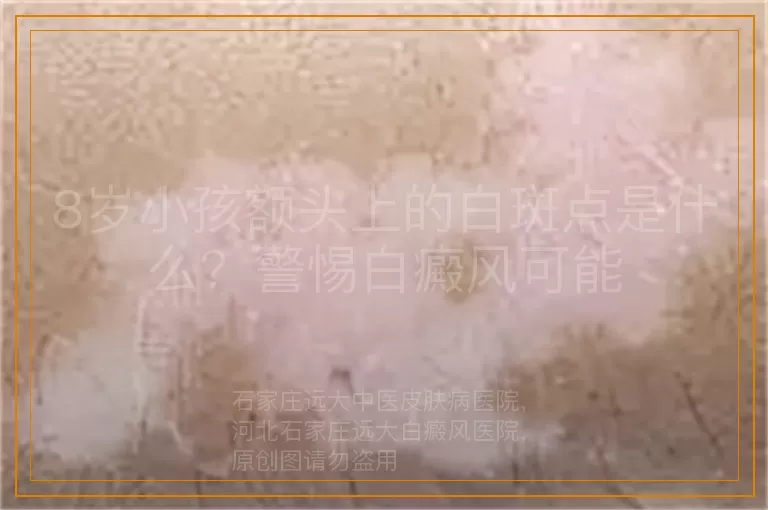 8岁小孩额头上的白斑点是什么？警惕白癜风可能