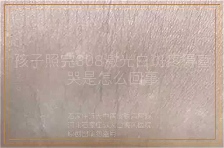 孩子照完308激光白斑疼得直哭是怎么回事