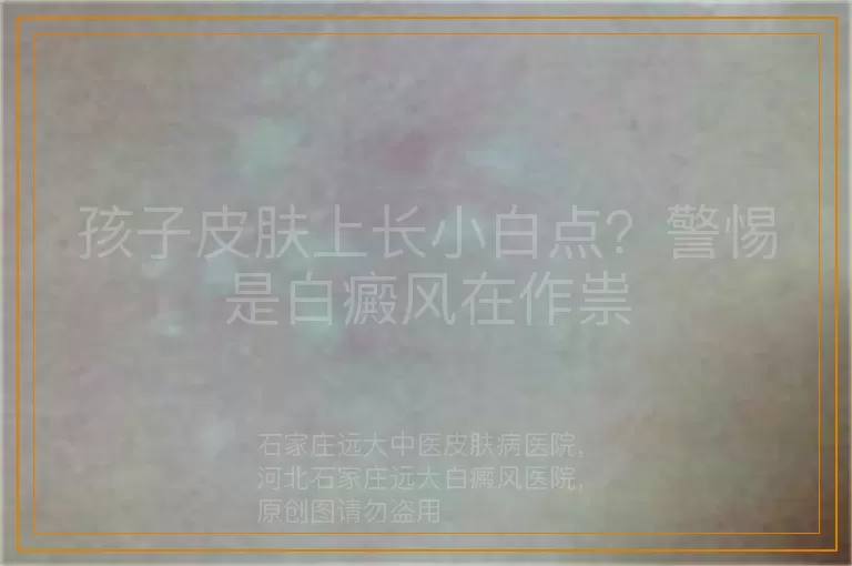 孩子皮肤上长小白点？警惕是白癜风在作祟