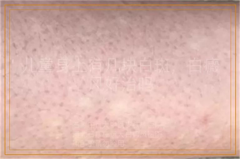儿童身上有几块白斑，白癜风好治吗