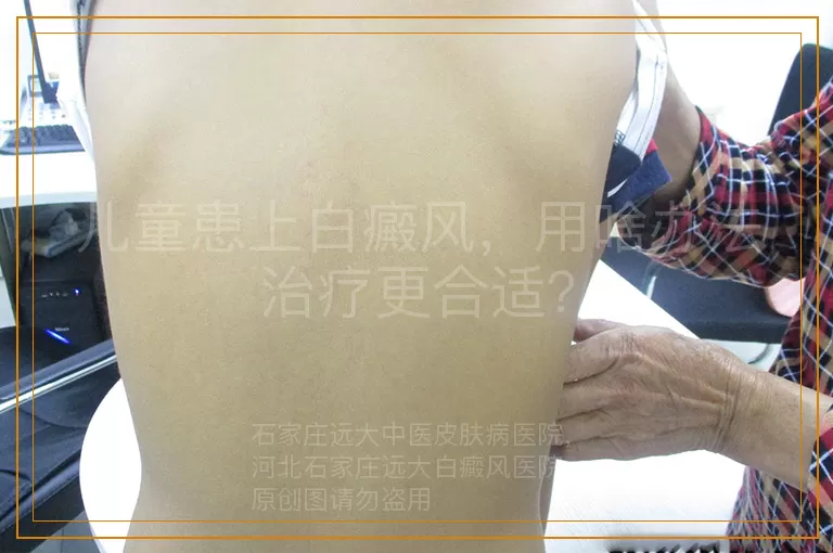 儿童患上白癜风，用啥办法治疗更合适？
