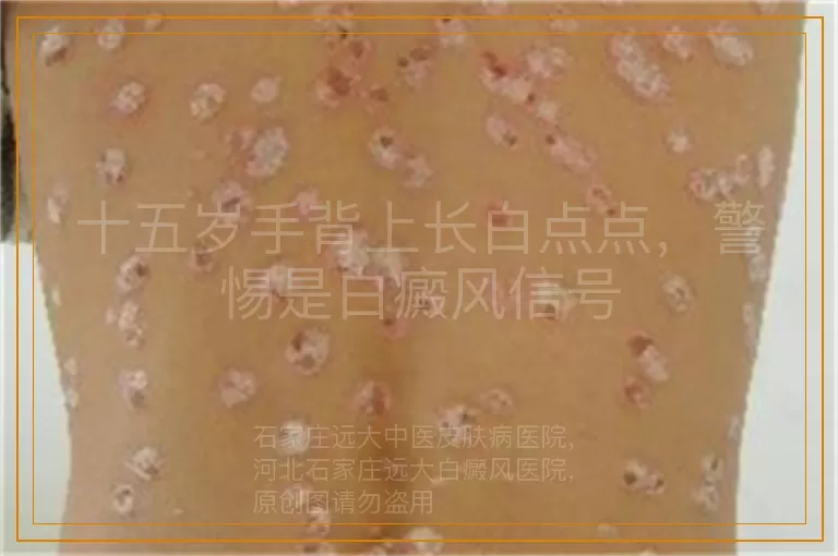 十五岁手背上长白点点，警惕是白癜风信号