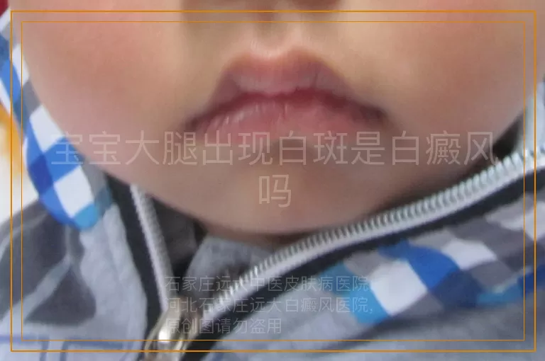 宝宝大腿出现白斑是白癜风吗
