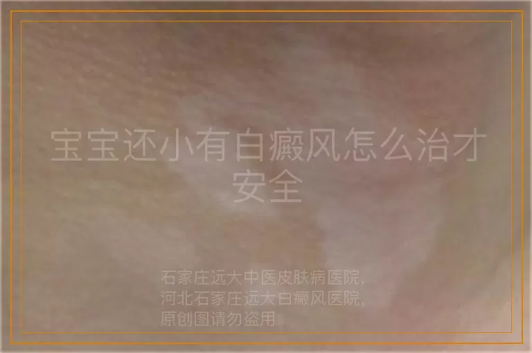 宝宝还小有白癜风怎么治才安全