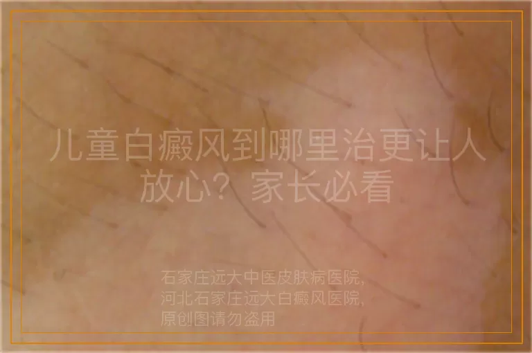 儿童白癜风到哪里治更让人放心？家长必看
