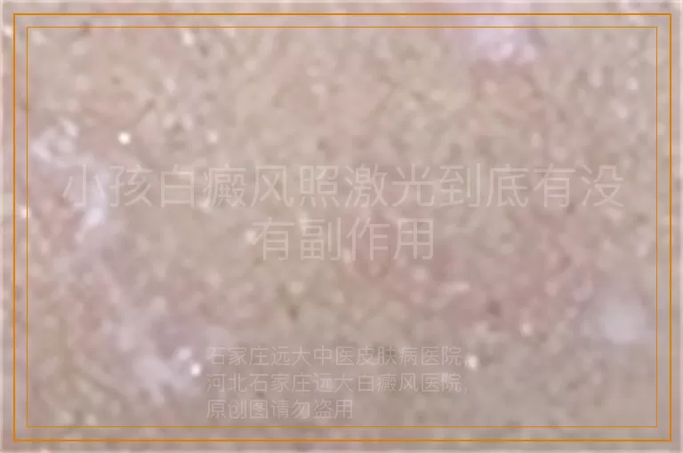 小孩白癜风照激光到底有没有副作用