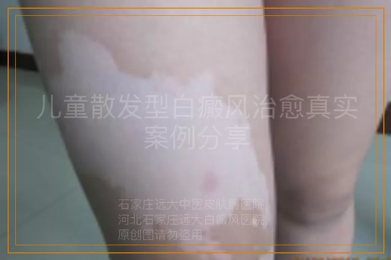 儿童散发型白癜风治愈真实案例分享