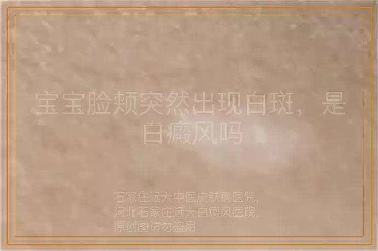 宝宝脸颊突然出现白斑，是白癜风吗