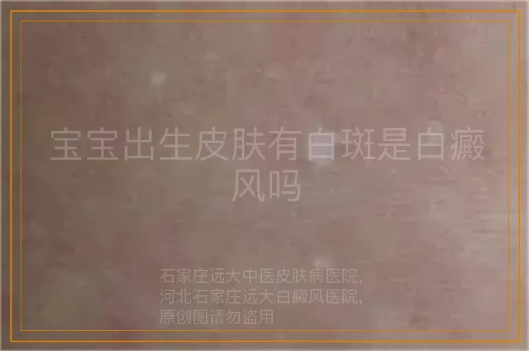 宝宝出生皮肤有白斑是白癜风吗