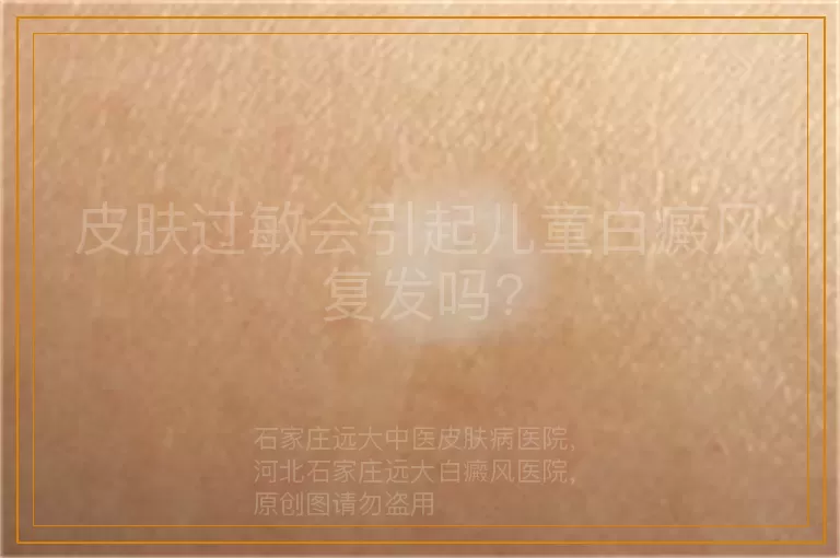 皮肤过敏会引起儿童白癜风复发吗?
