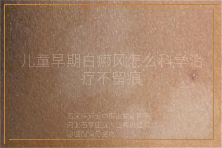 儿童早期白癜风怎么科学治疗不留痕