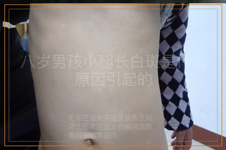 八岁男孩小腿长白斑是什么原因引起的