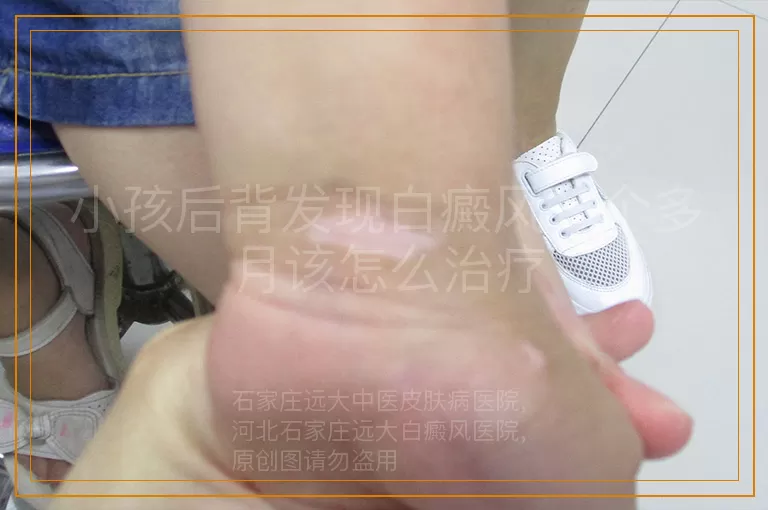 小孩后背发现白癜风一个多月该怎么治疗