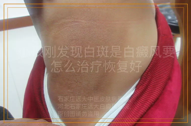 小孩刚发现白斑是白癜风要怎么治疗恢复好